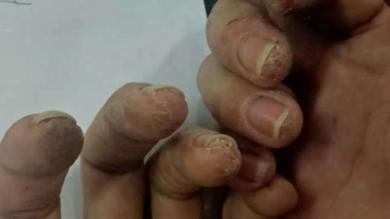 dầu nhớt ăn da tay