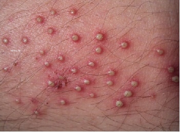 viêm nang lông do da tiếp xúc với dung dịch gia công kim loại