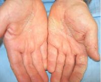 Dầu gia công cắt gọt kim loại gây viêm da kích ứng ăn da tay