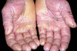 dầu gia công kim loại gây kích ứng da