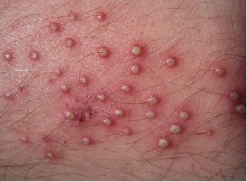 dầu gia công cắt gọt kim loại gây viêm nang lông